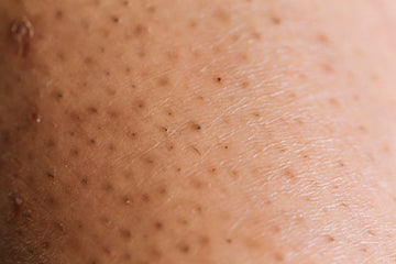 PCOS? Hirsutism?