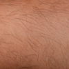 PCOS? Hirsutism?