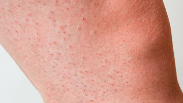 Strawberry skin?